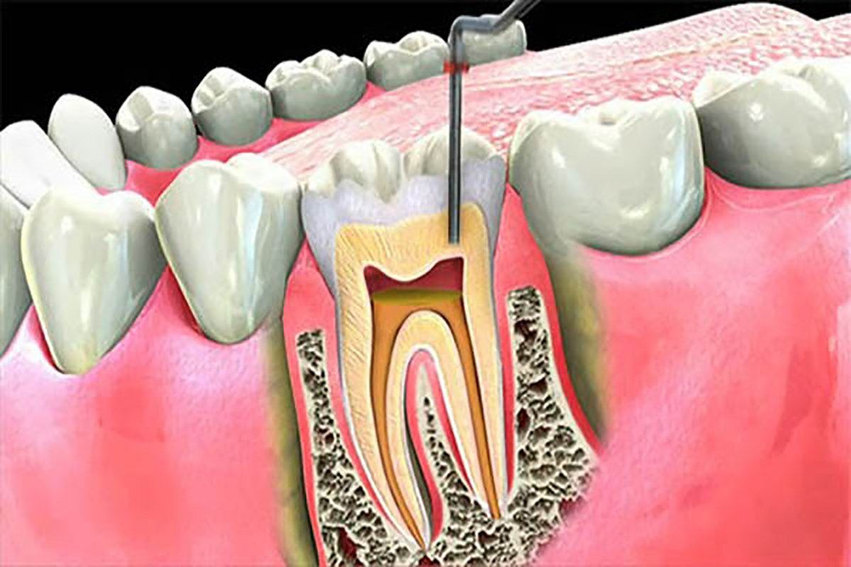 Endodoncia