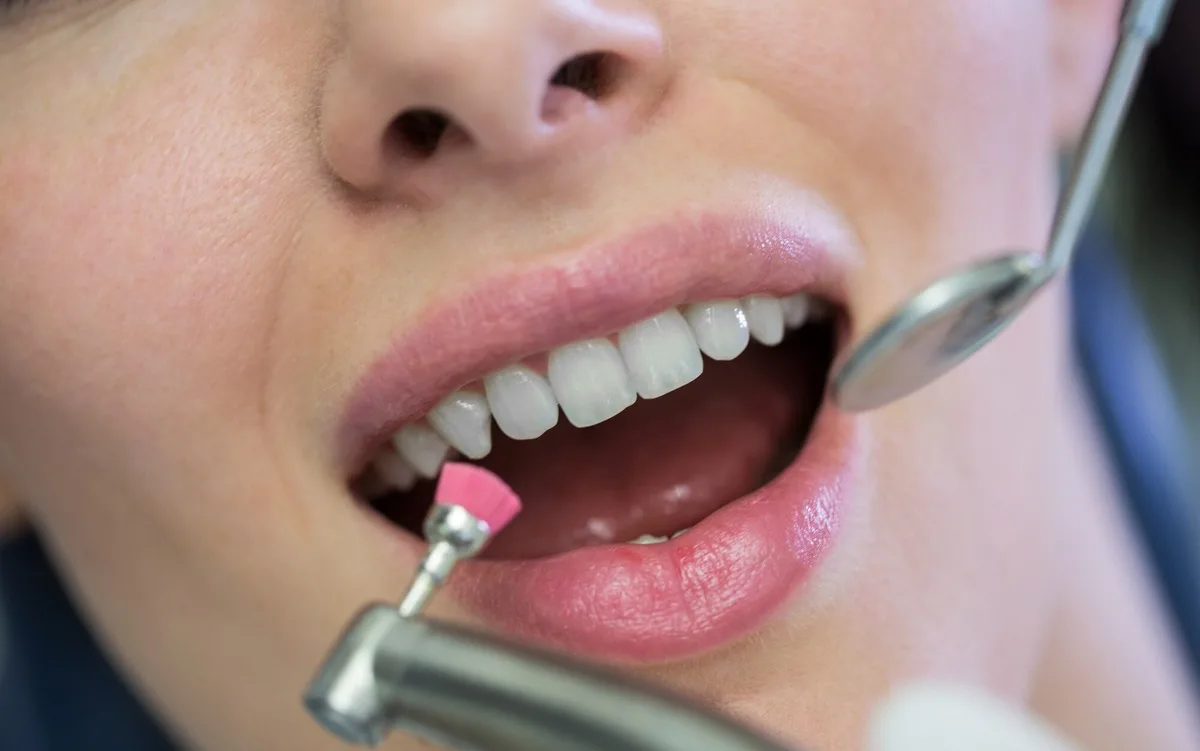 Limpieza dental
